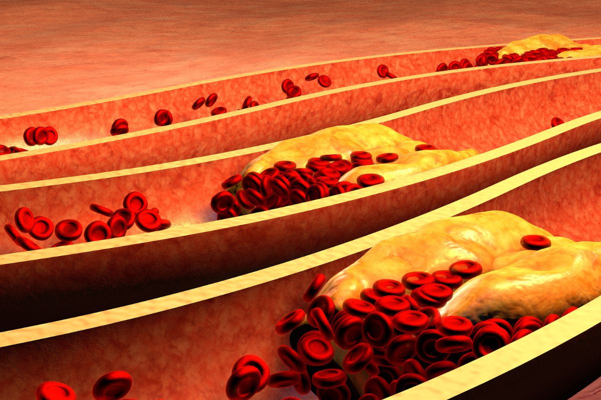 Can Arterial Plaque Be Reversed Or Reduced?
