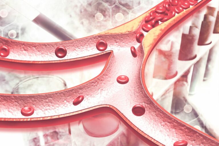 Can Arterial Plaque Be Reversed Or Reduced? Alpha Nutrition