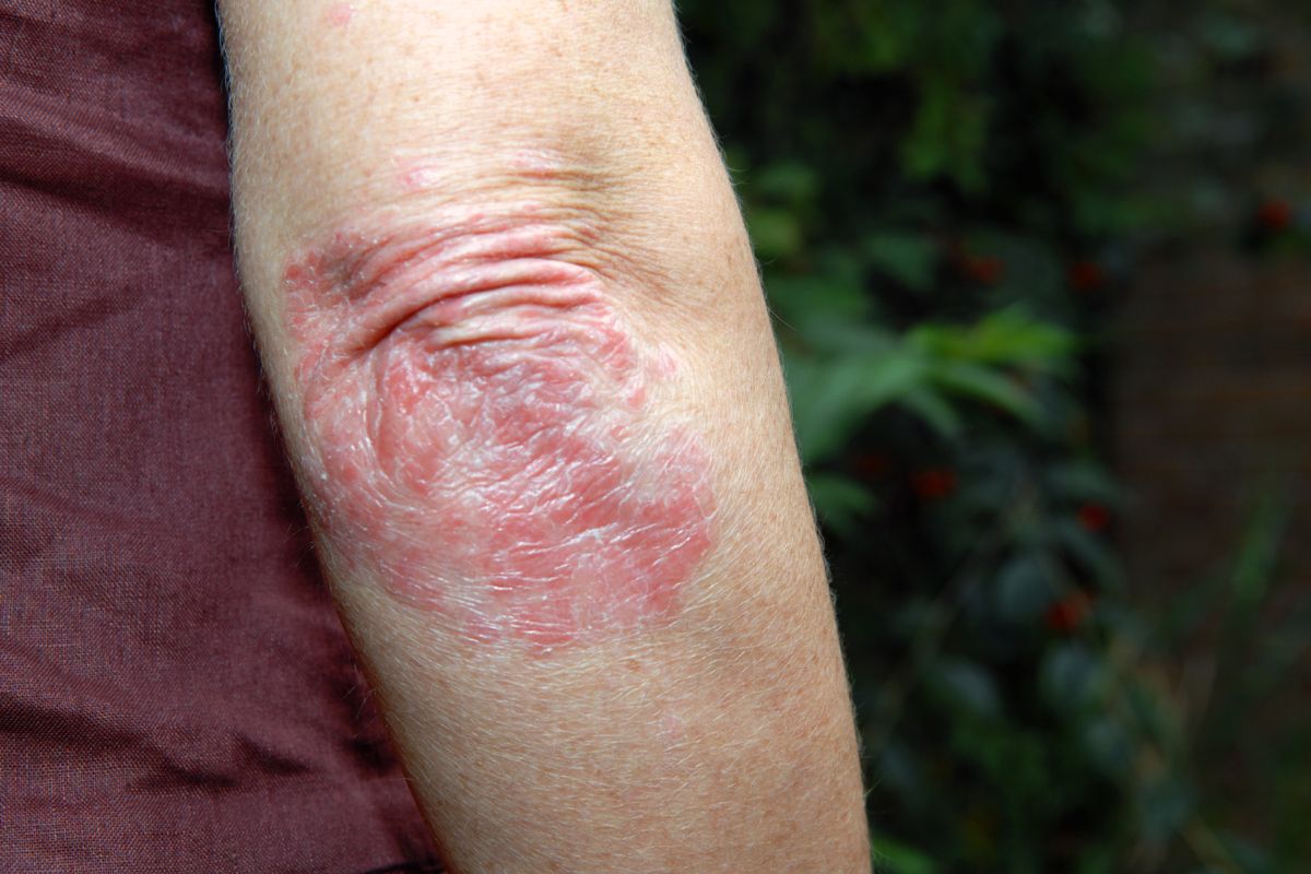 Can Coconut Oil Help Treat Psoriasis? (All You Need to Know) 