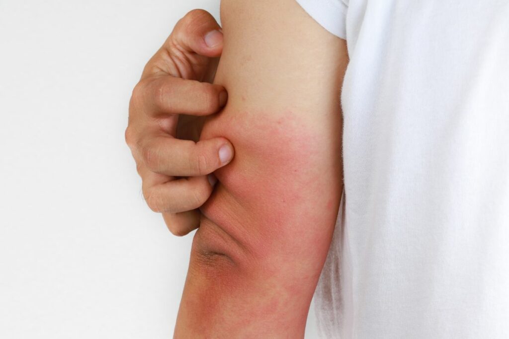 Eczema Treatments Can Saltwater Improve Your Skin? Alpha Nutrition