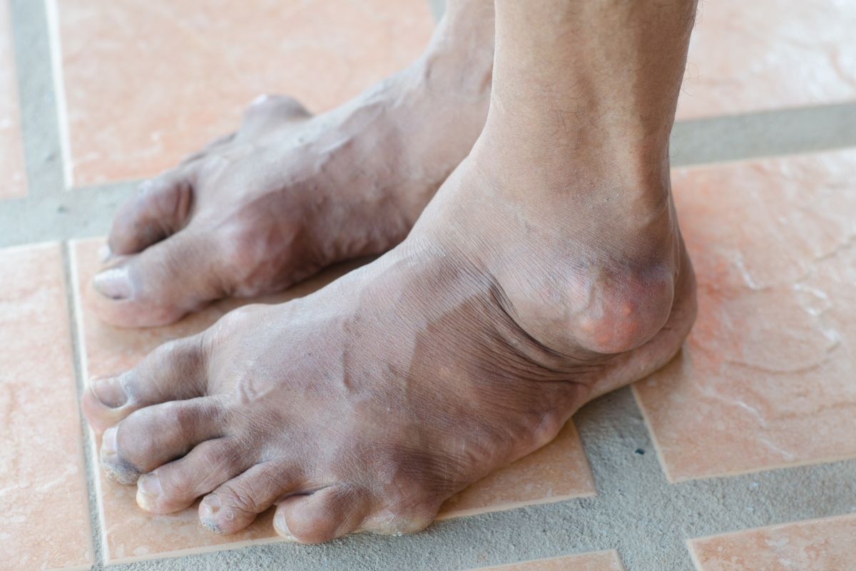 Gout Pain: Causes And Flare Up Triggers 