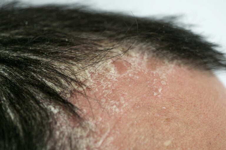 Is Short Hair Better For Scalp Psoriasis All You Need To Know Alpha Nutrition