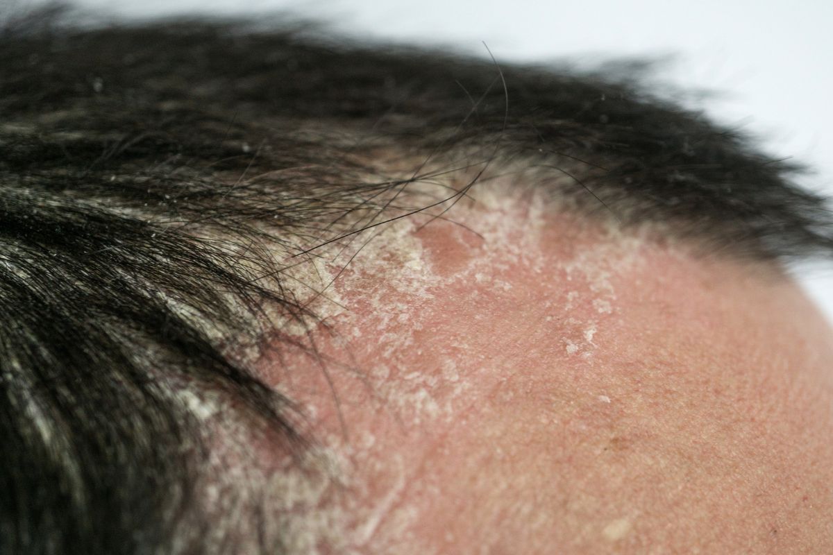 Is Short Hair Better For Scalp Psoriasis? (All You Need To Know) 