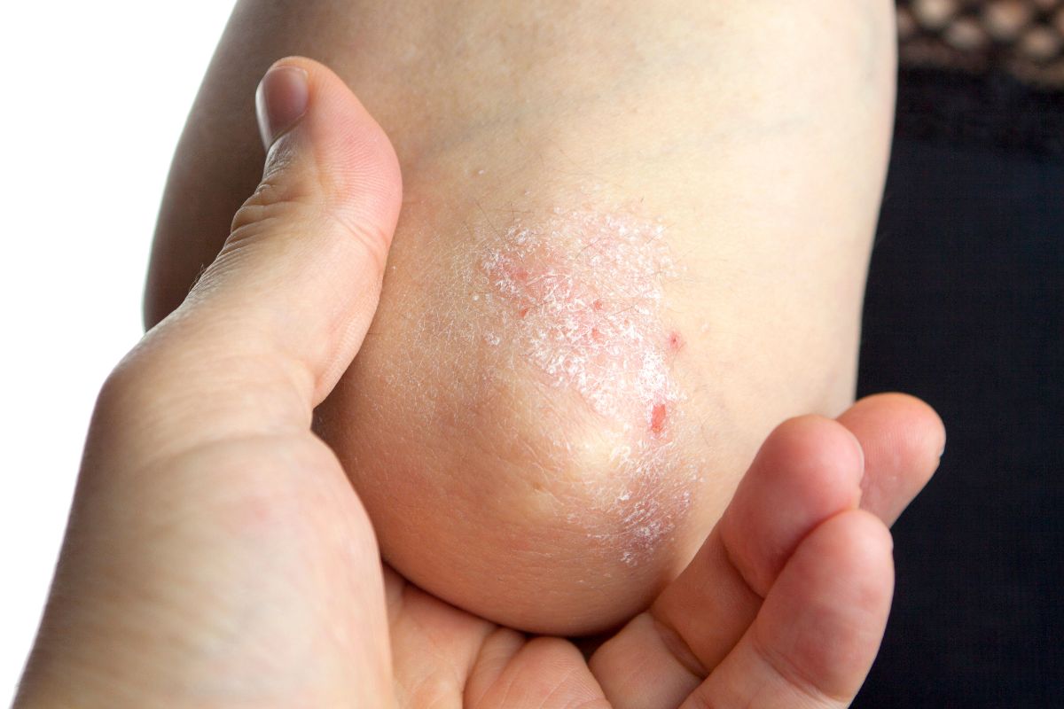 Psoriasis - Can it Be Cured? Treatments and Long Term Effects