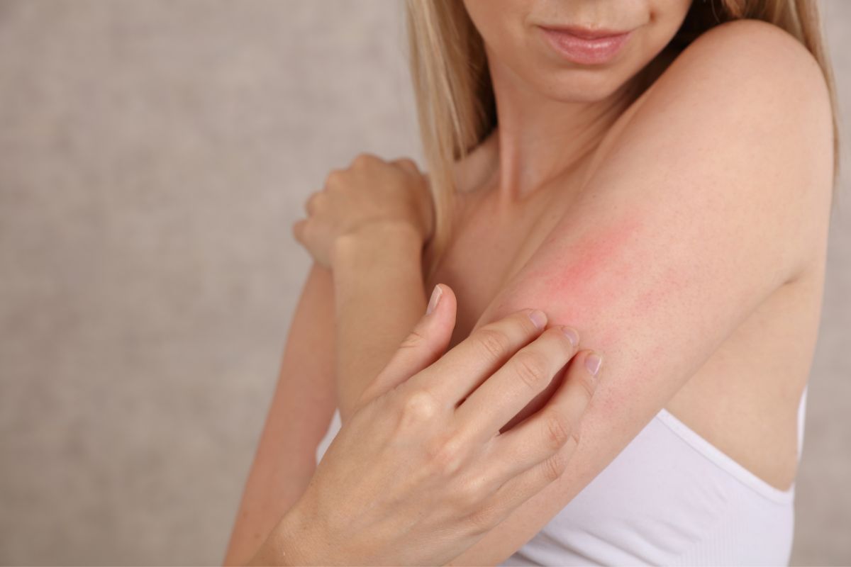 Sun Exposure And Eczema: Can It Help?