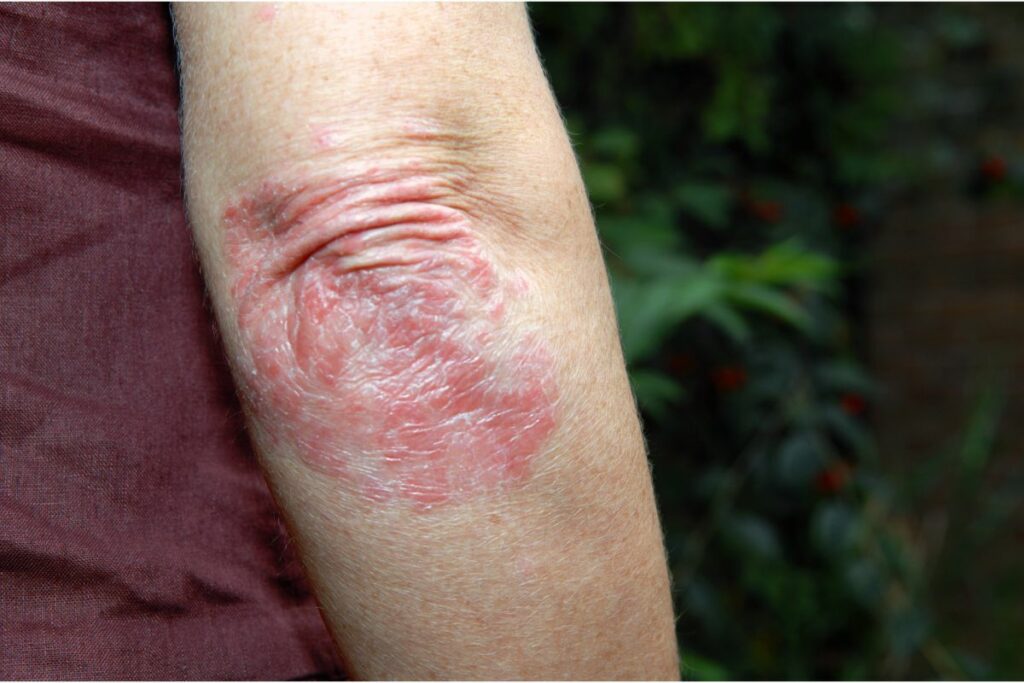 10 Best Creams for Psoriasis FlareUps Alpha Nutrition