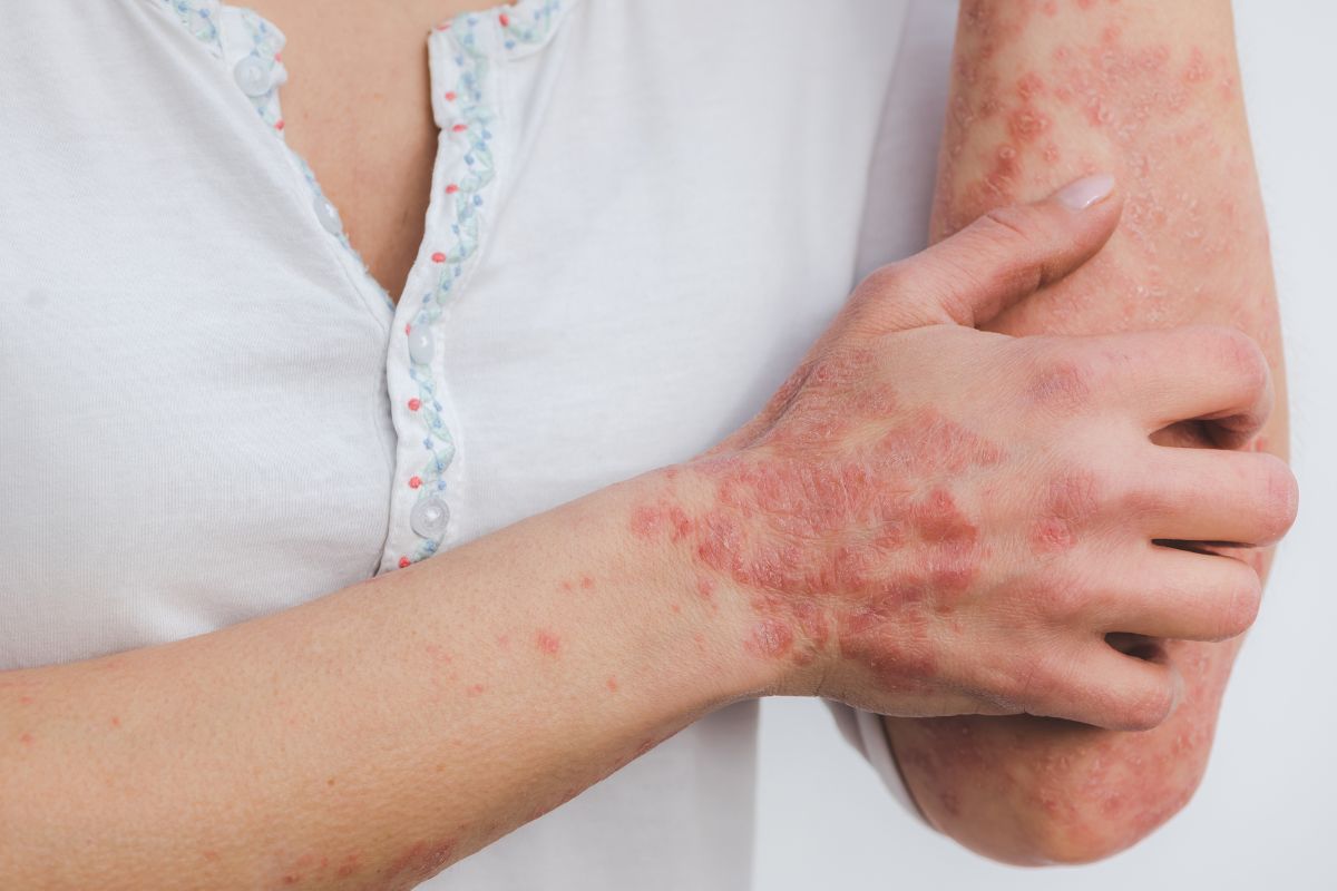 Best Psoriasis Medication & Other Recommended Treatments
