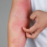 Moisturizing to Reduce Eczema (All You Need to Know)