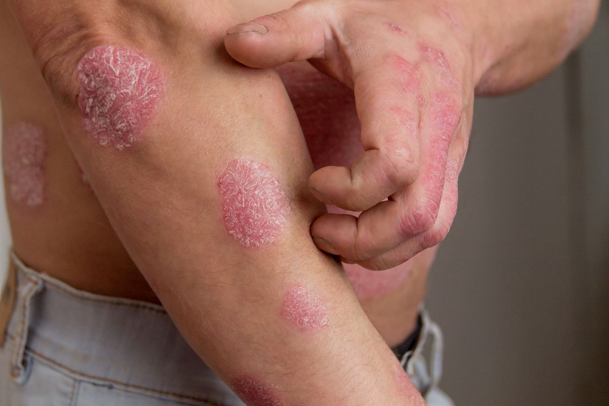 Psoriasis: How Does It Spread?