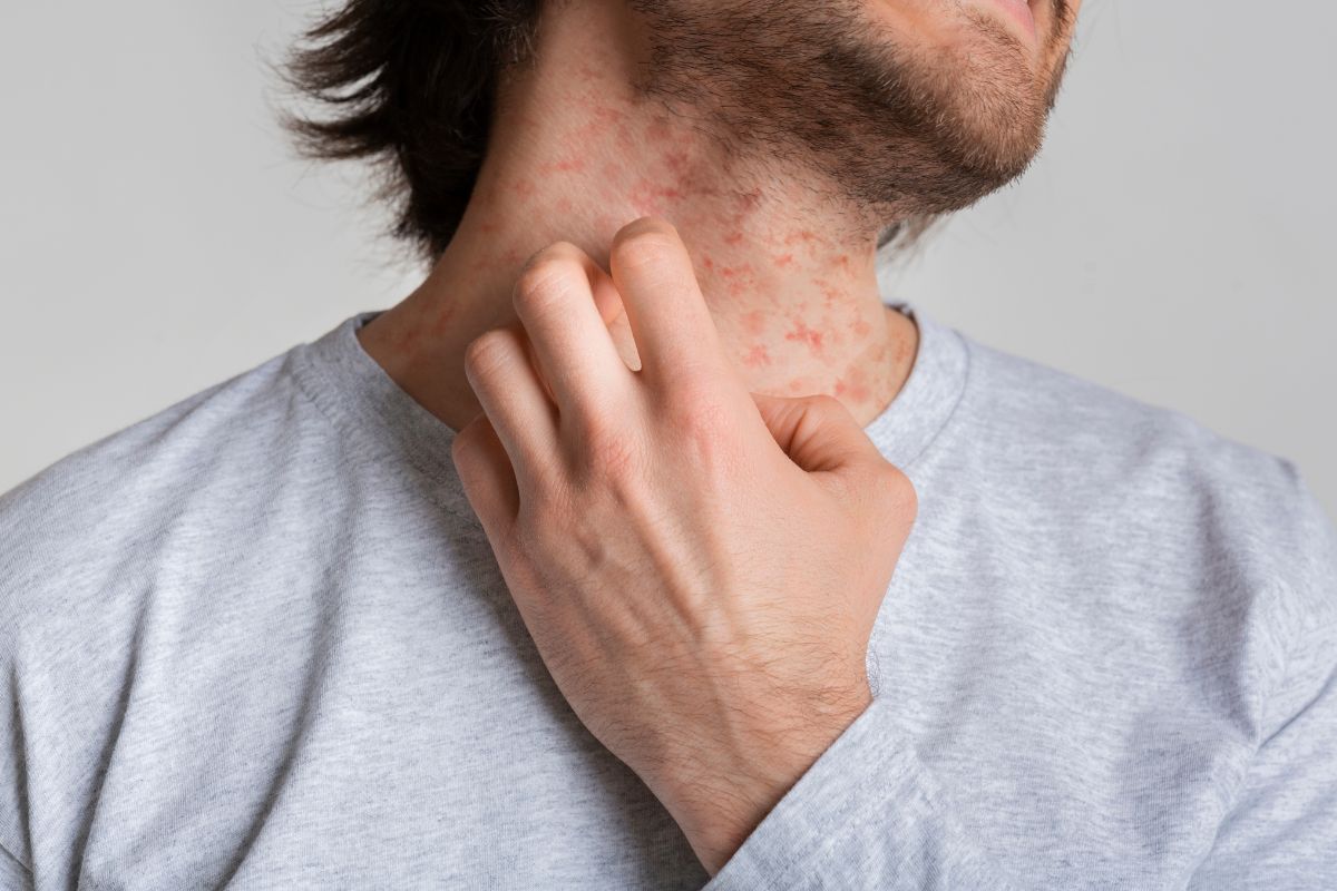 Why You Shouldn't Ignore Your Eczema? (Best Treatment Options)
