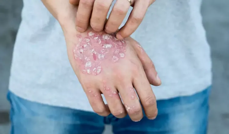 Psoriasis as an Autoimmune Disorder